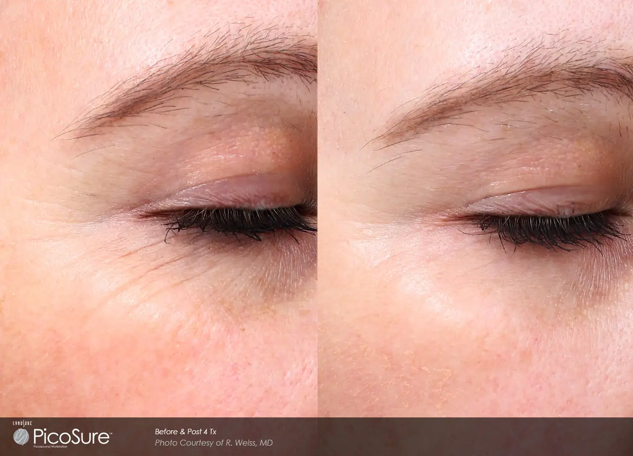 PicoSure before and after result