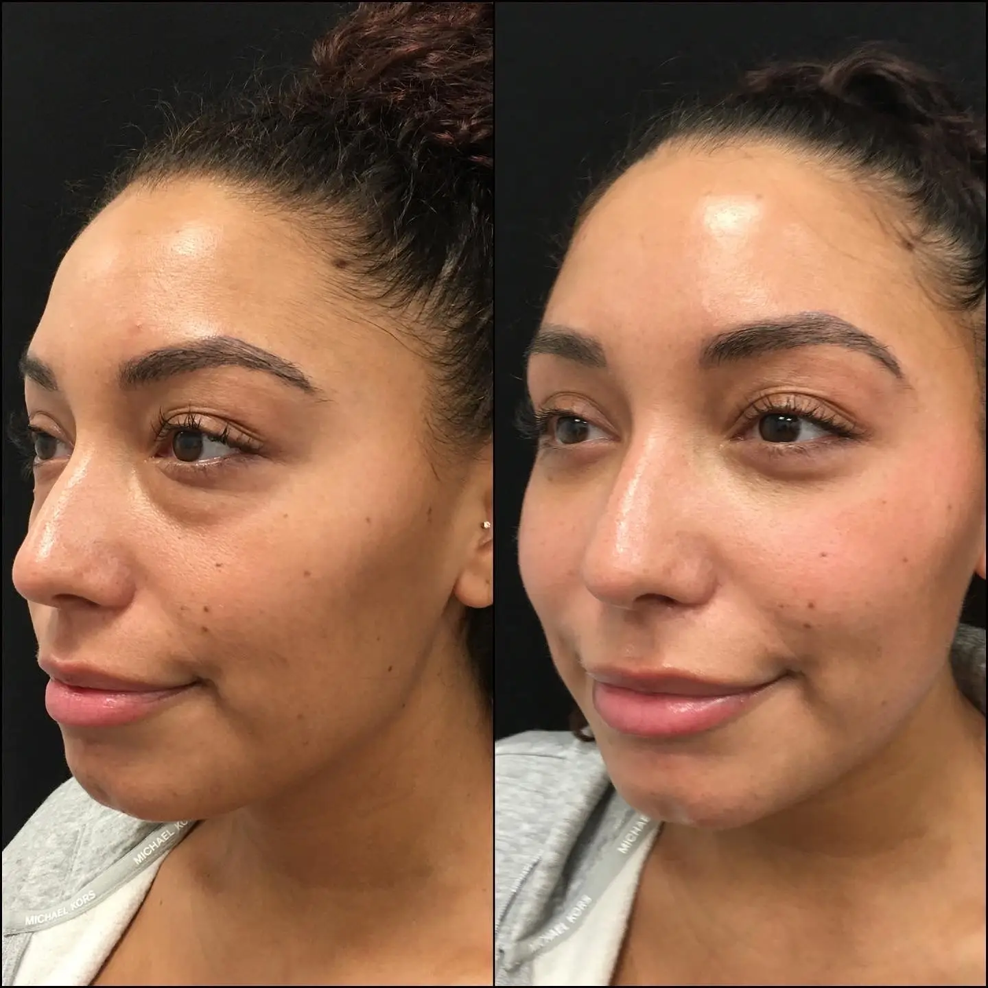 Under-eye bag treatment before and after result