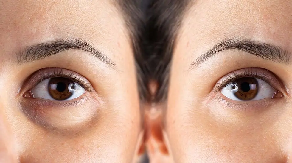 Under-eye bag treatment before and after result