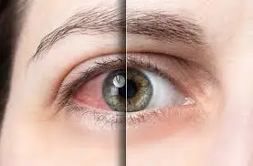 Dry eye treatment before and after result