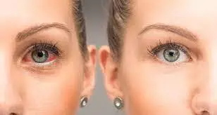 Dry eye treatment before and after result