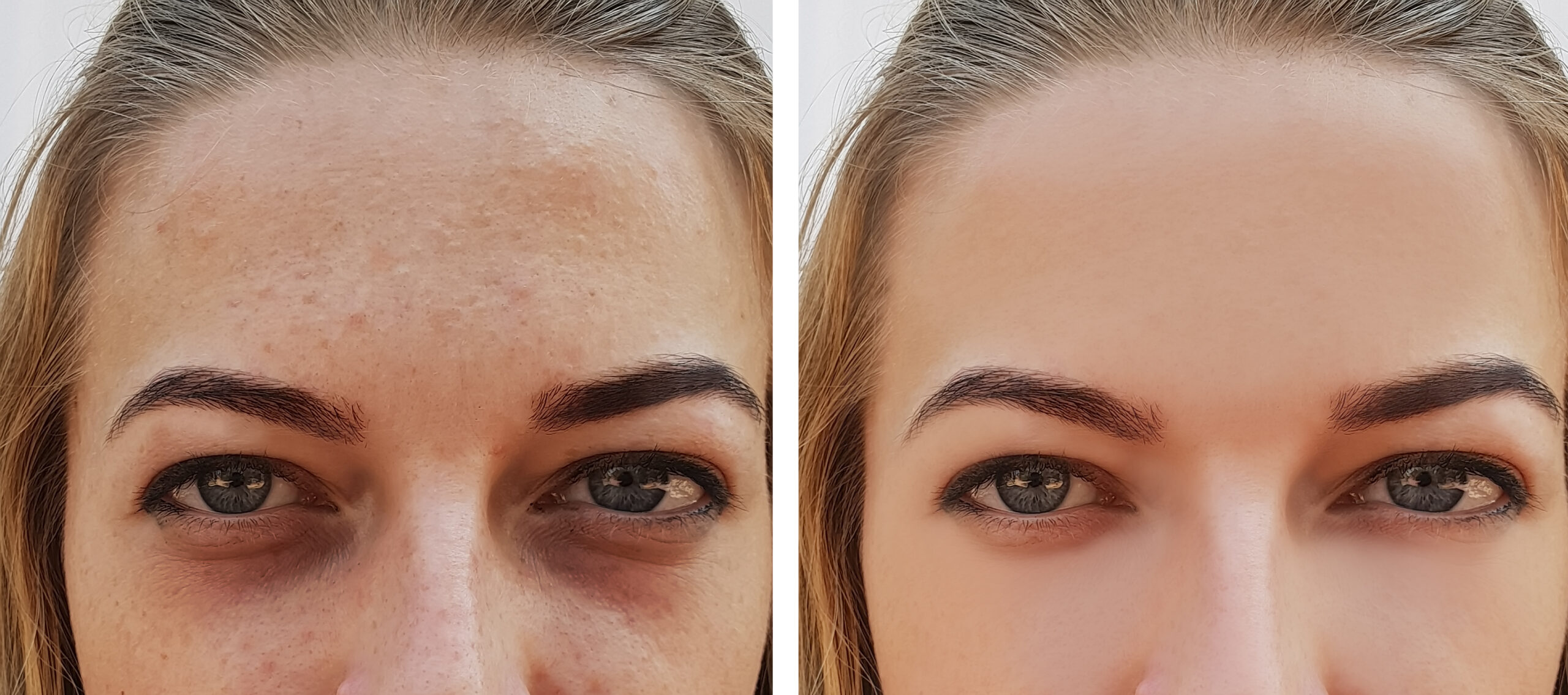 eye girl bag under the eyes before and after