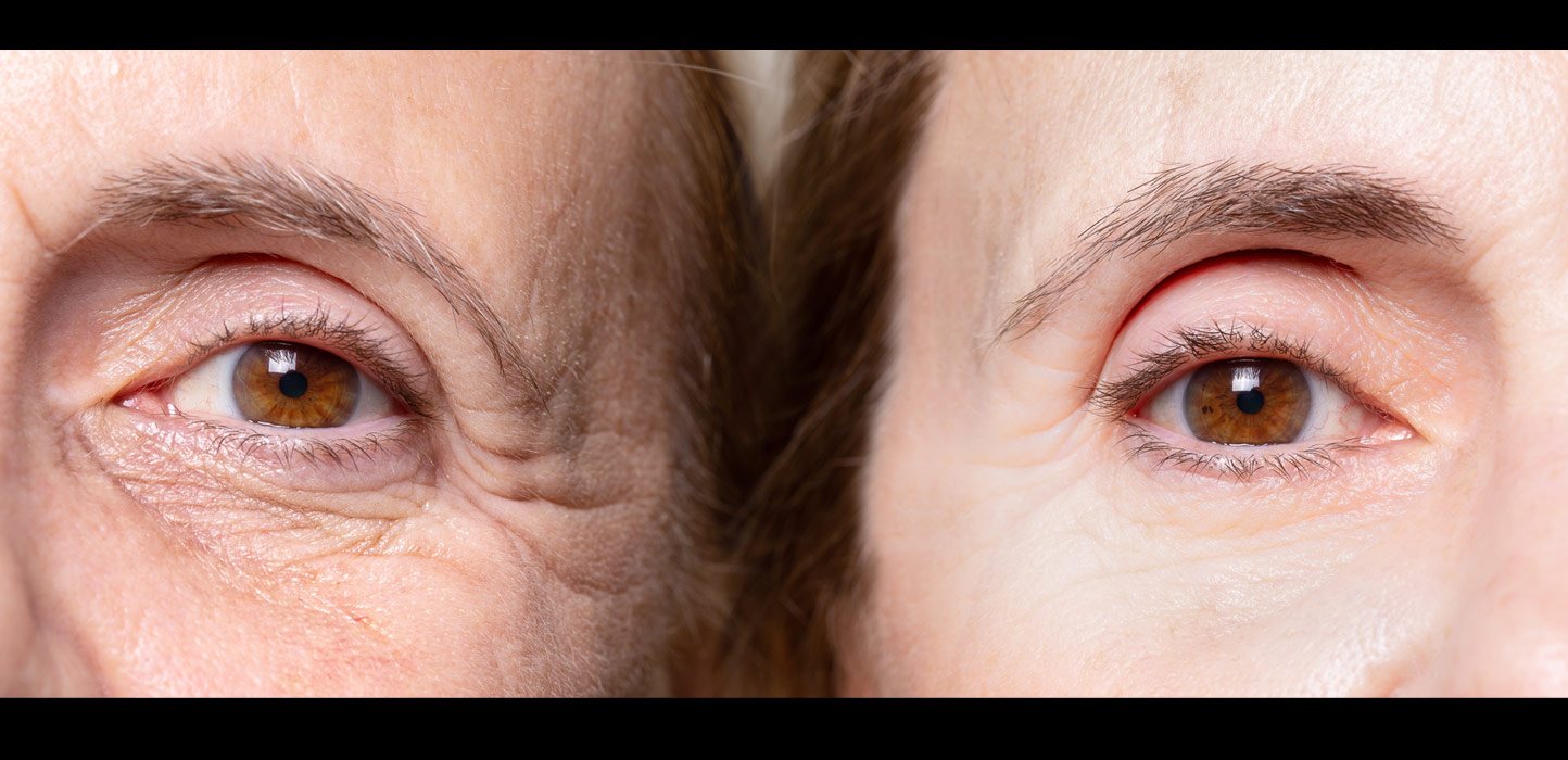 under eye botox before and after
