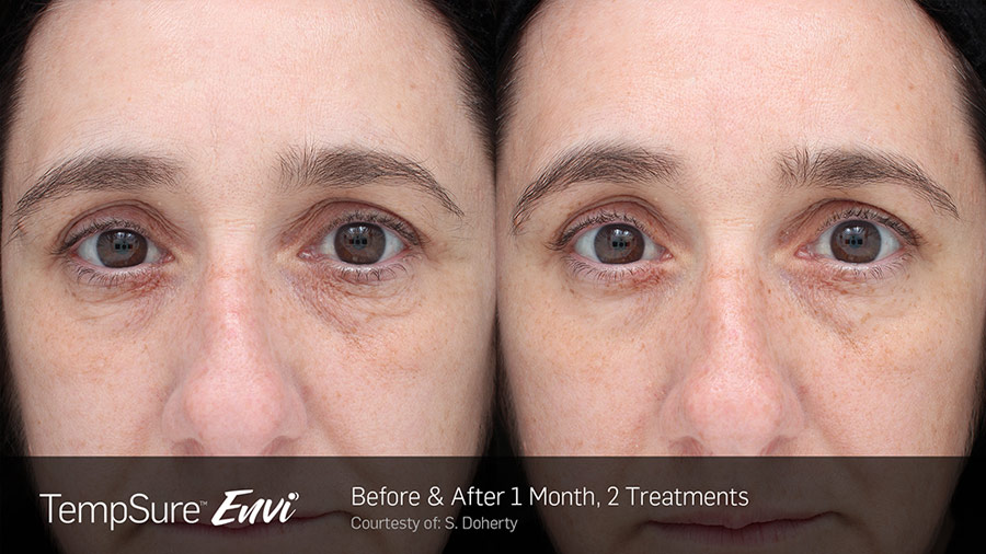 TempSure Envi - before and after