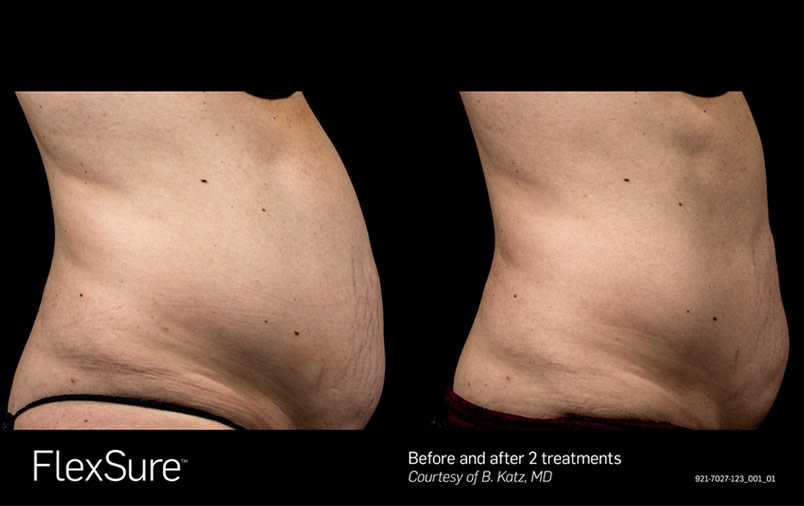Flexsure Body Tightening - before and after