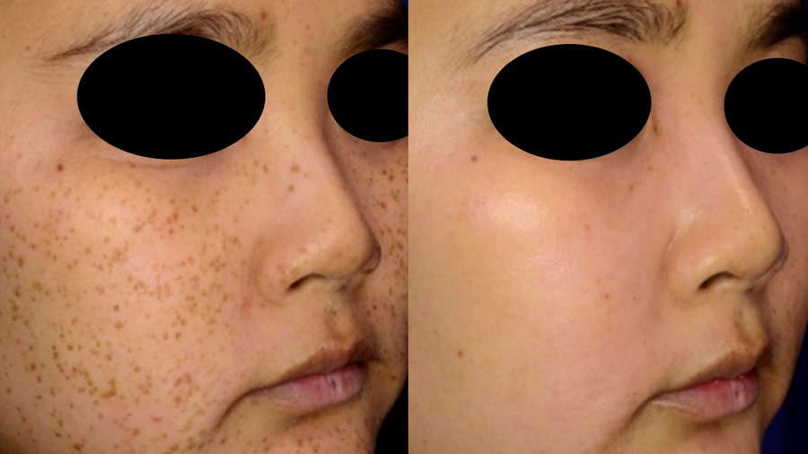 Brown Spots Treatments