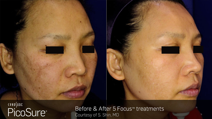 Pigmentation and Brown Spots Treatments