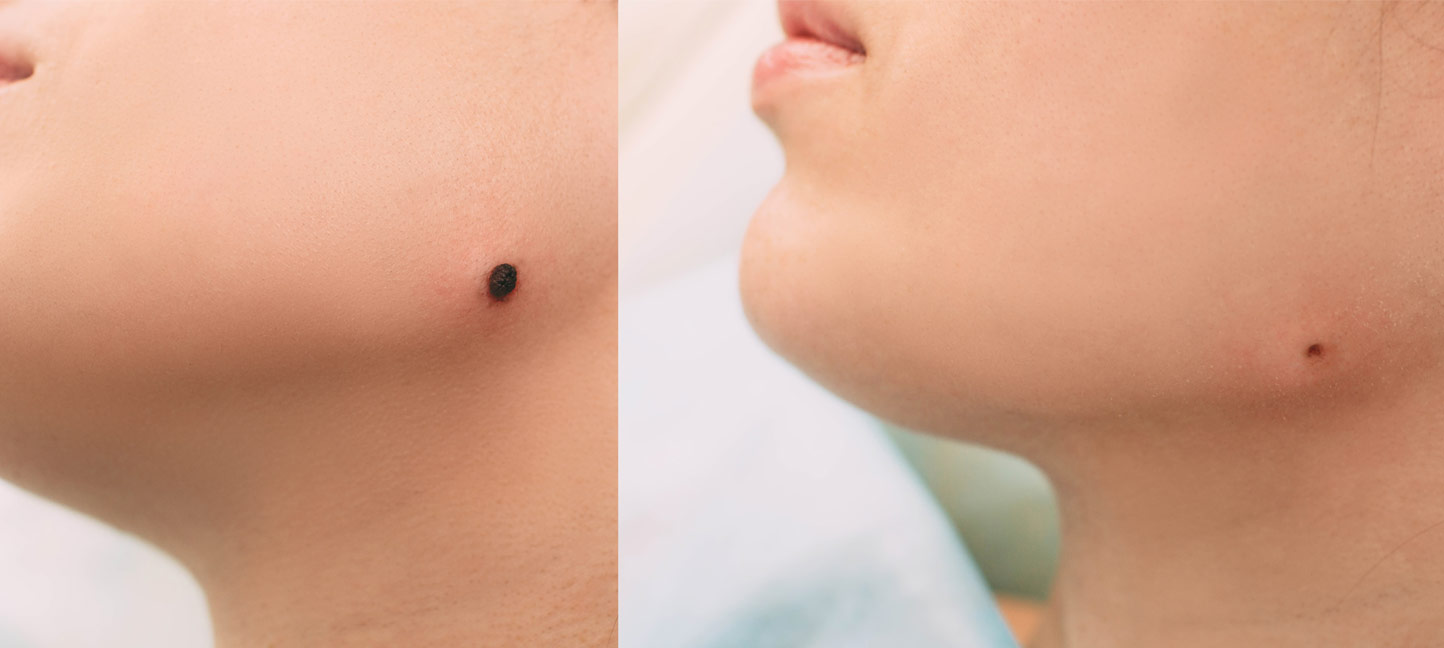 Mole Removal - before and after