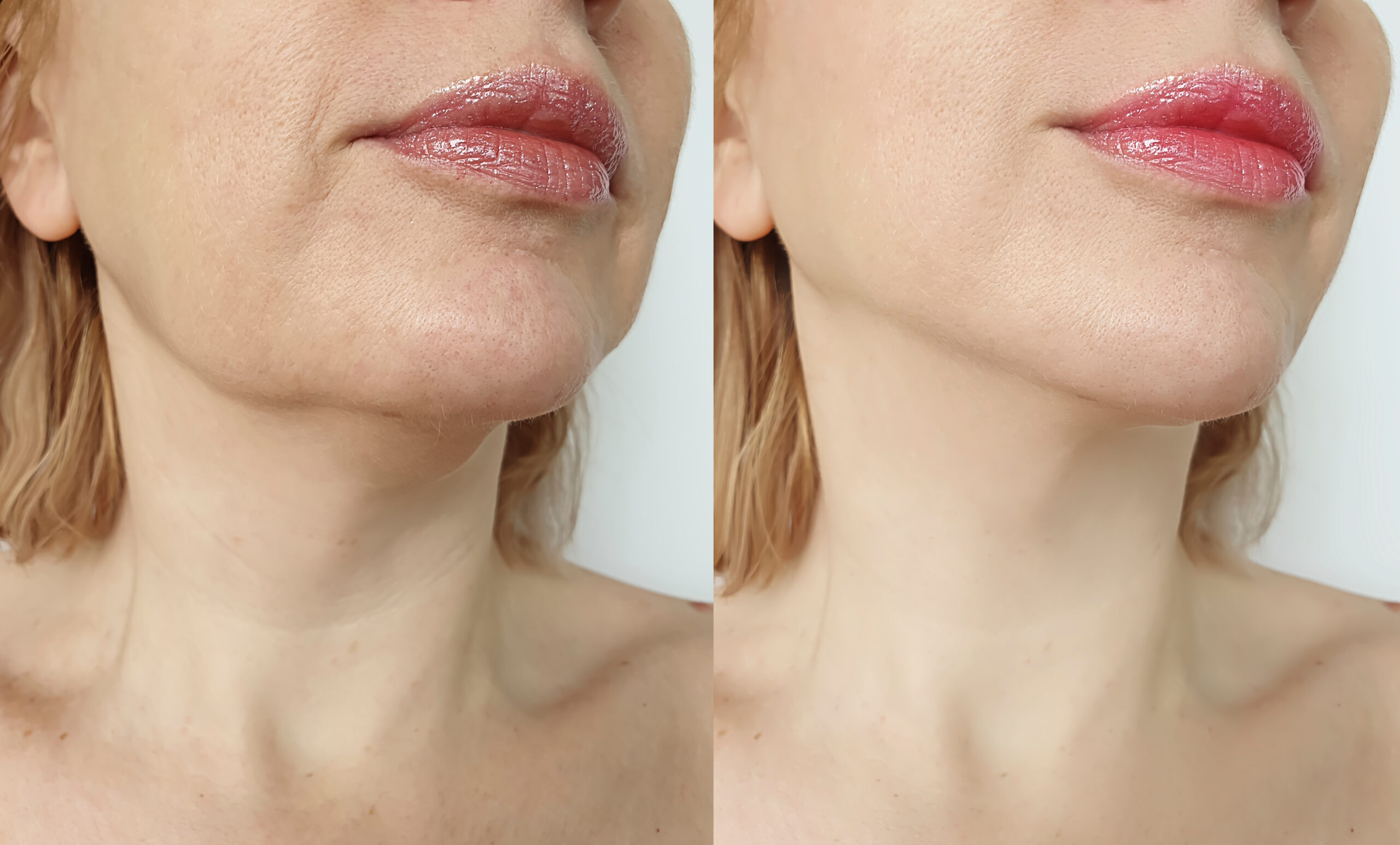 Female Double Chin - After Correction