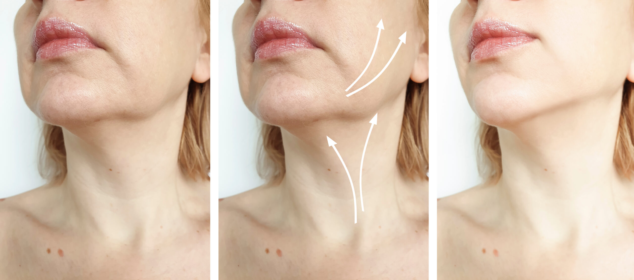 Double Chin - Before And After Treatment