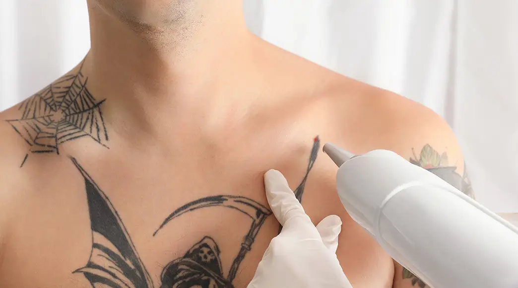 removing tattoo